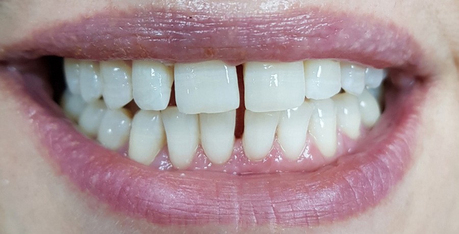 Before Whitening-Laser 3